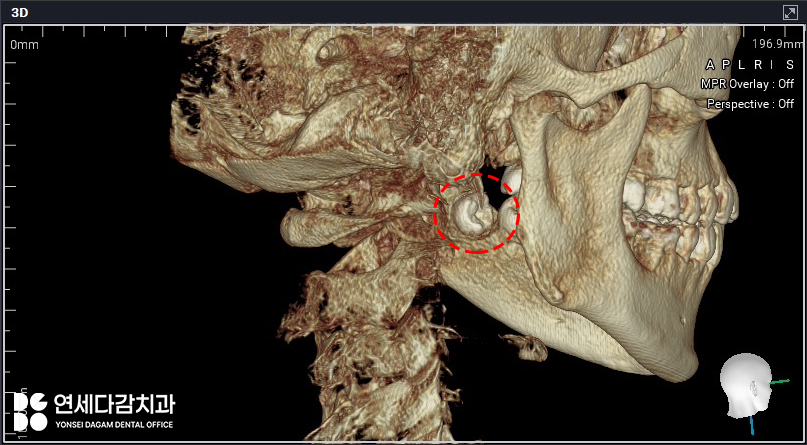 복잡한 매복 사랑니 발치 오금동 치과 에서 CT 촬영을 통한 분석 과정 관련 이미지 2