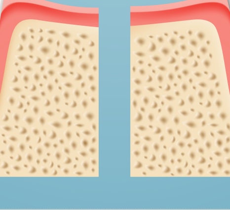 종로치과 충치가 생겼을 때 어떻게 치료 받아야 하나요? 관련 이미지 17
