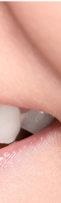 종로치과 라미네이트 주변 치아를 확인하여 자연스럽게 관련 이미지 15