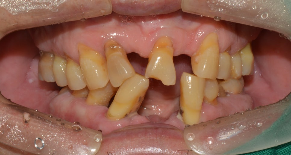 종로치과추천 이가 흔들려서 씹는게 불편해요 관련 이미지 4