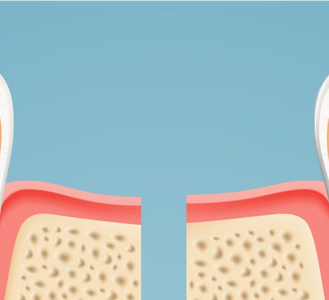 종로치과 충치가 생겼을 때 어떻게 치료 받아야 하나요? 관련 이미지 11