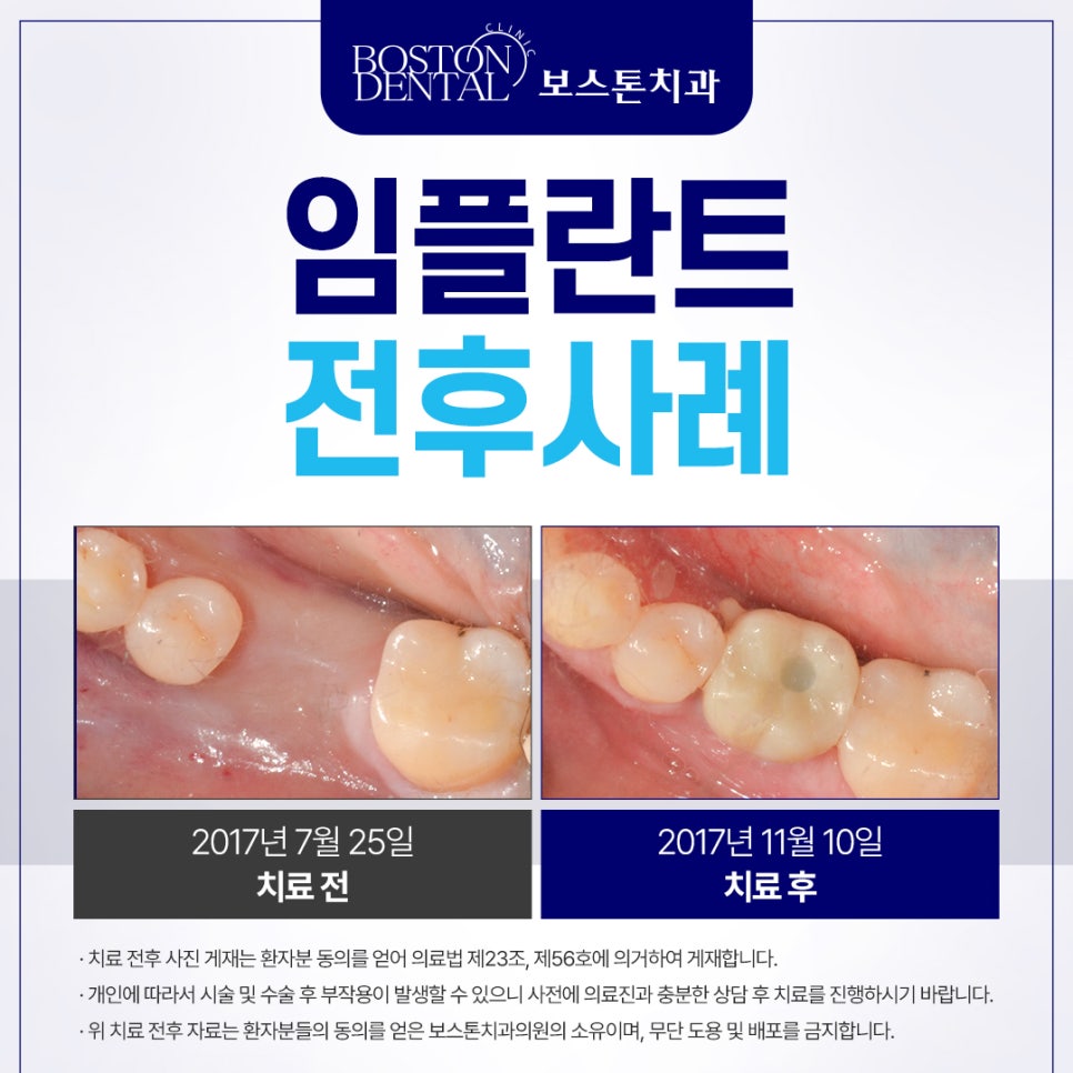 종로구치과 발치한지 2~3년이 지났어요 관련 이미지 2