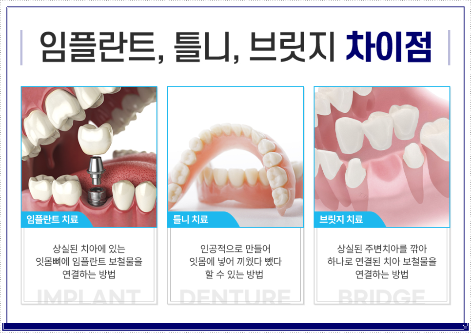 종로치과 왜 임플란트일까? 관련 이미지 5