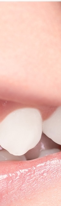 종로치과 라미네이트 주변 치아를 확인하여 자연스럽게 관련 이미지 14