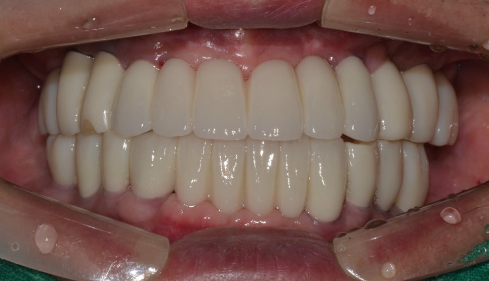 명동치과 잇몸이 안좋고 이가 계속 빠져서 밥먹기가 힘들어요. 관련 이미지 5