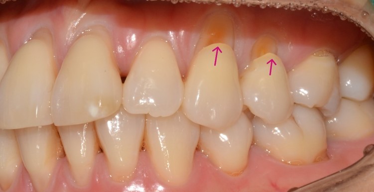 종로치과 치아 마모 때문에 이가 너무 시려요! 관련 이미지 2