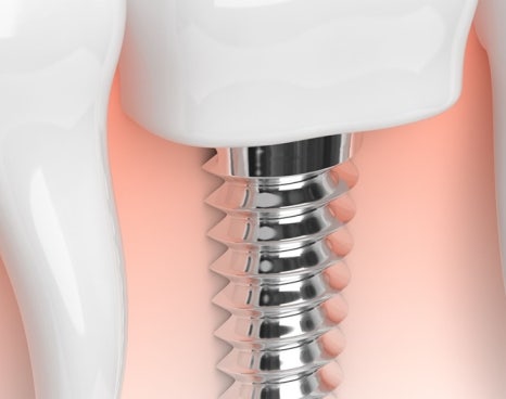 종각치과 너무 많은 치과 치료가 헷갈린다면? 관련 이미지 16