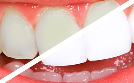 종로치과 치아미백 밝고 환하게 관련 이미지 20