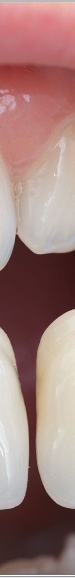 명동치과 치아 라미네이트의 모든 것: 앞니부터 어금니까지 관련 이미지 14