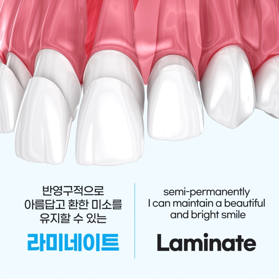 종각치과에서 알려드리는 치아미백과 라미네이트 이후의 달라진 일상 관련 이미지 9