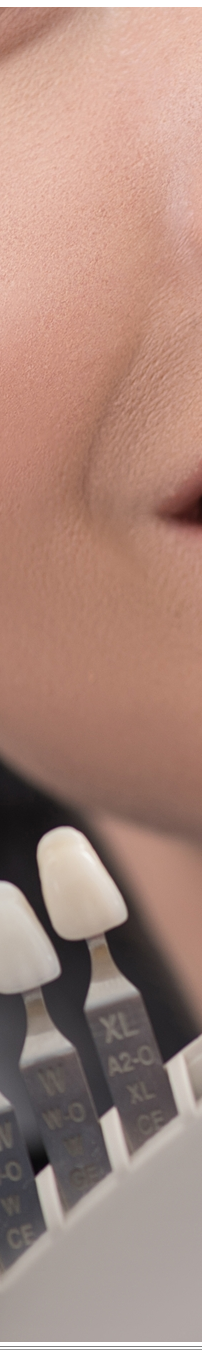 광화문역치과 치아미백과 라미네이트 나에게 필요한 건? 관련 이미지 16