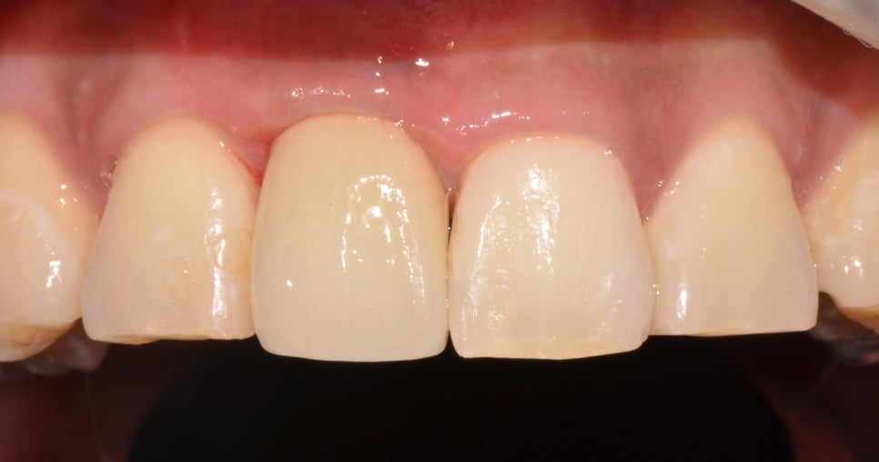 종로구치과 교통사고 나서 병 같은 게 부딪혀 앞니가 깨졌어요. 관련 이미지 4