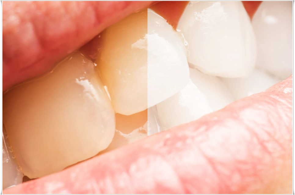 종로치과에서 알려드리는 치아미백과 라미네이트의 모든 것 관련 이미지 1