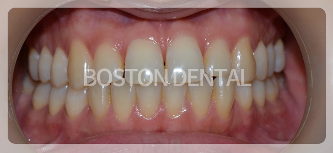 종로치아미백 환한 자신감! 관련 이미지 4