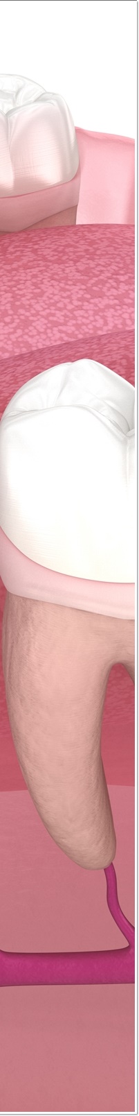 종각역치과 자연치아를 살리기 위한 대책, 신경치료 관련 이미지 16