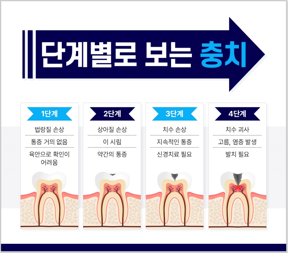 충치, 치료 미루면 더 아프고 더 비싸집니다 &ndash; 종각치과에서 꼭 알아야 할 이야기 관련 이미지 3