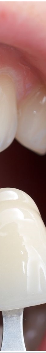 명동치과 치아 라미네이트의 모든 것: 앞니부터 어금니까지 관련 이미지 15