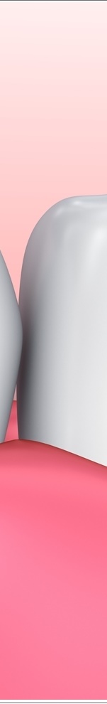 광화문치과 라미네이트 치료 전 고민해야 할 것 관련 이미지 21