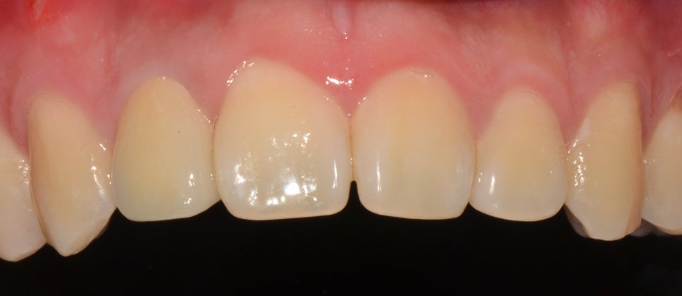 을지로치과 예전에 신경치료한 치아가 음식먹다가 부러졌어요. 관련 이미지 4