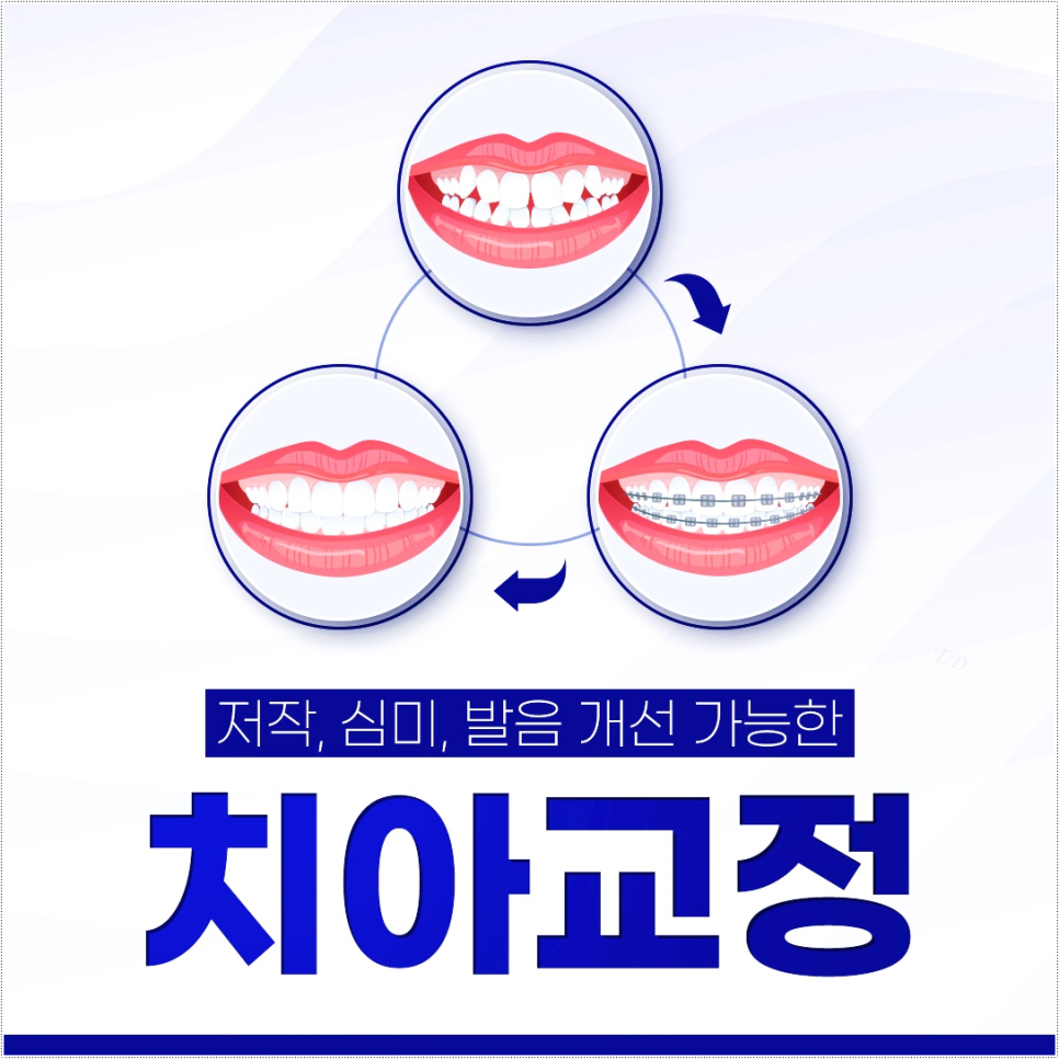 을지로입구역치과에서 알려드리는 인비절라인의 모든 것 관련 이미지 2