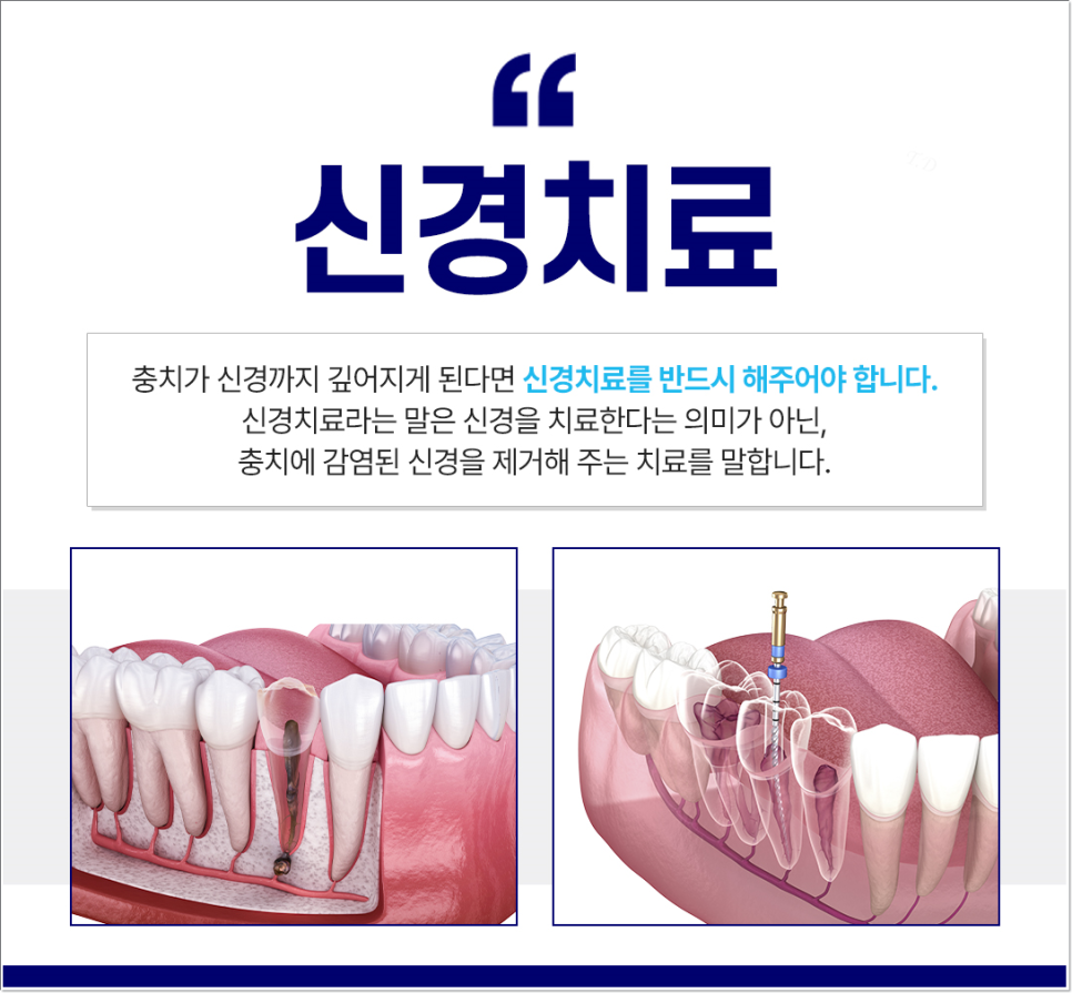 종각역치과 충치를 방치하면 신경치료를 해야 한다. 관련 이미지 2