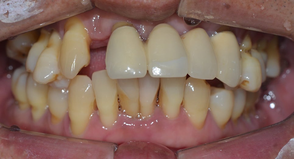 종로치과 잇몸이 붓고 전체적으로 이가 흔들려서 힘들어요 관련 이미지 2