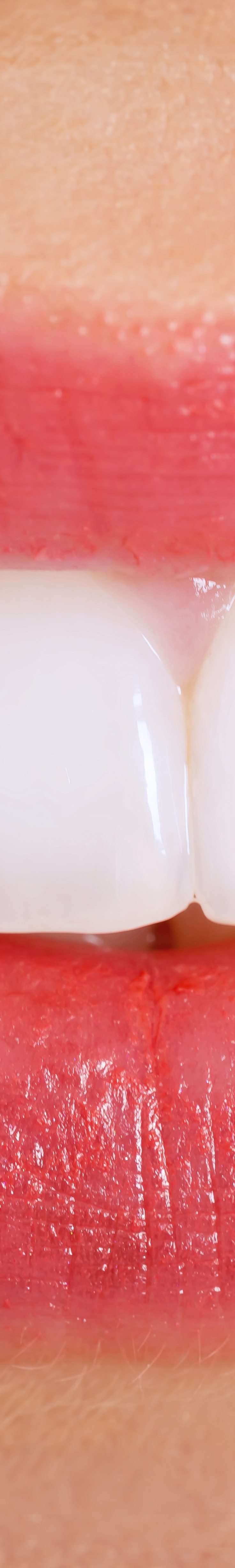 [종각역치과] 치아가 누렇게 보이는 진짜 이유, 미백 전에 꼭 알아야 할 것들 관련 이미지 13