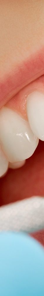 광화문치과 치아미백 그 후 관련 이미지 11