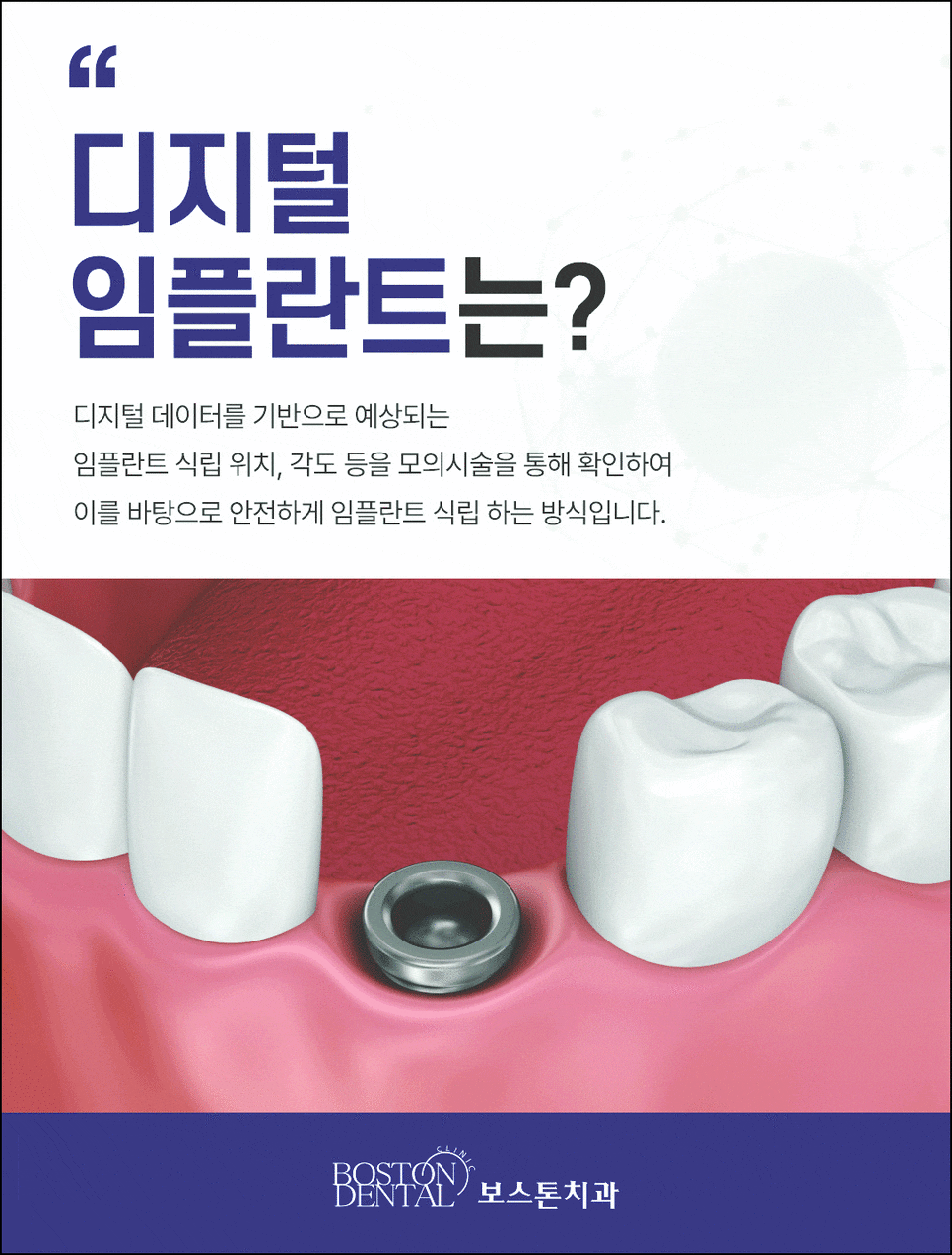 종로3가치과 임플란트 후에 관리를 꼭 해줘야 하는 이유 관련 이미지 4