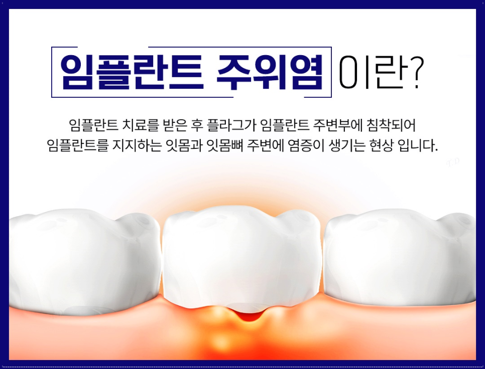 종각역치과 임플란트 치료, 이것만은 알고 계세요! 관련 이미지 7