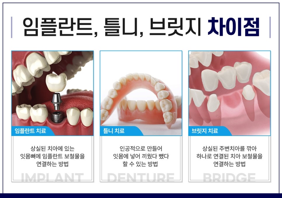 종각치과 임플란트 치료 후 관리 관련 이미지 3
