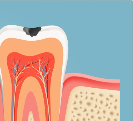 종로치과 충치가 생겼을 때 어떻게 치료 받아야 하나요? 관련 이미지 12