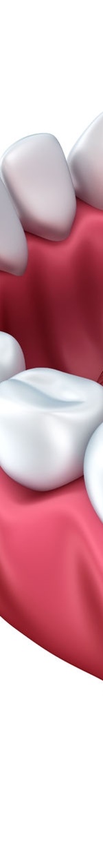 종각역치과 충치를 방치하면 신경치료를 해야 한다. 관련 이미지 9