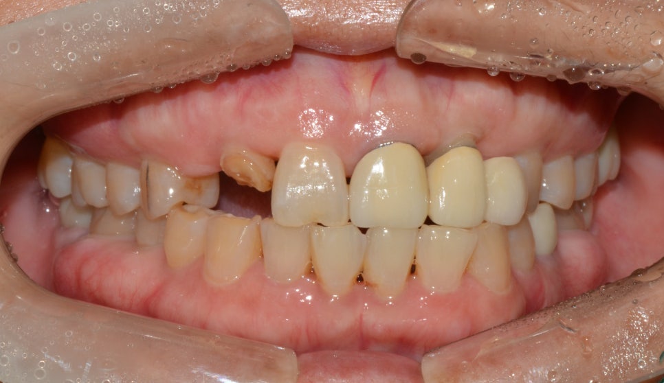 종로임플란트 아래 치아가 계속 위에 치아랑 닿는 거 같더니 위에 앞니가 깨졌어요 관련 이미지 4