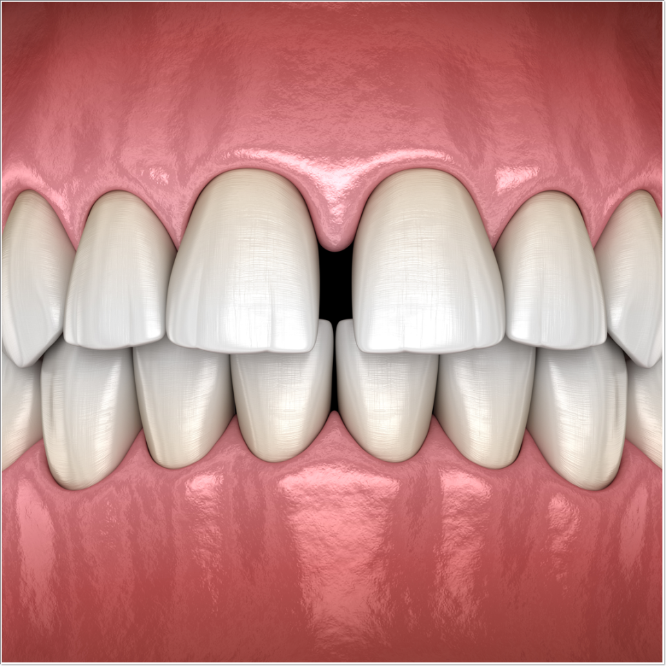 치아 변색 고민 끝, 을지로치과에서 듣는 라미네이트 사례 관련 이미지 15