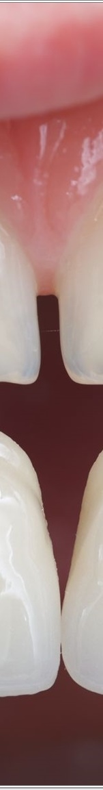 명동치과 치아 라미네이트의 모든 것: 앞니부터 어금니까지 관련 이미지 12