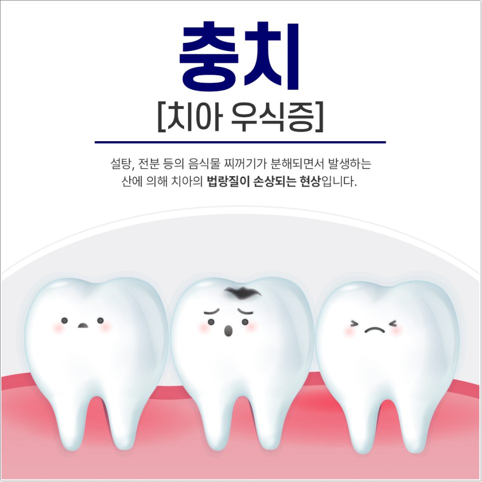 종각역치과 충치를 방치하면 신경치료를 해야 한다. 관련 이미지 3