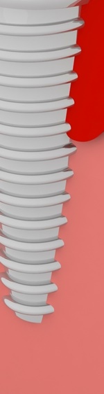 광화문치과 라미네이트 깨짐&middot;들뜸 원인과 예방 방법 완벽 정리 관련 이미지 20