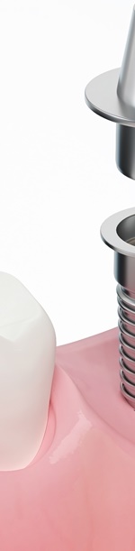 종로치과추천 나이별 &middot; 상황별 임플란트 치료 방법 관련 이미지 25