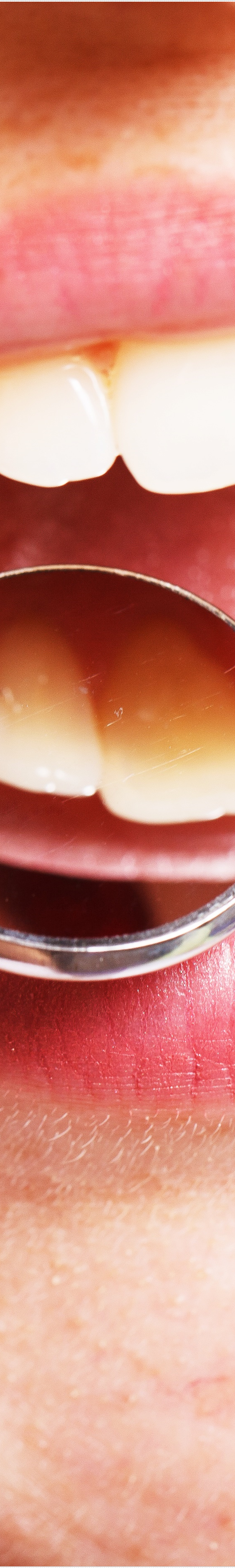 을지로입구역치과에서 알려드리는 치아미백과 라미네이트의 모든 것 관련 이미지 14