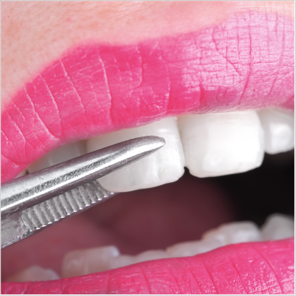 치아 변색 고민 끝, 을지로치과에서 듣는 라미네이트 사례 관련 이미지 23