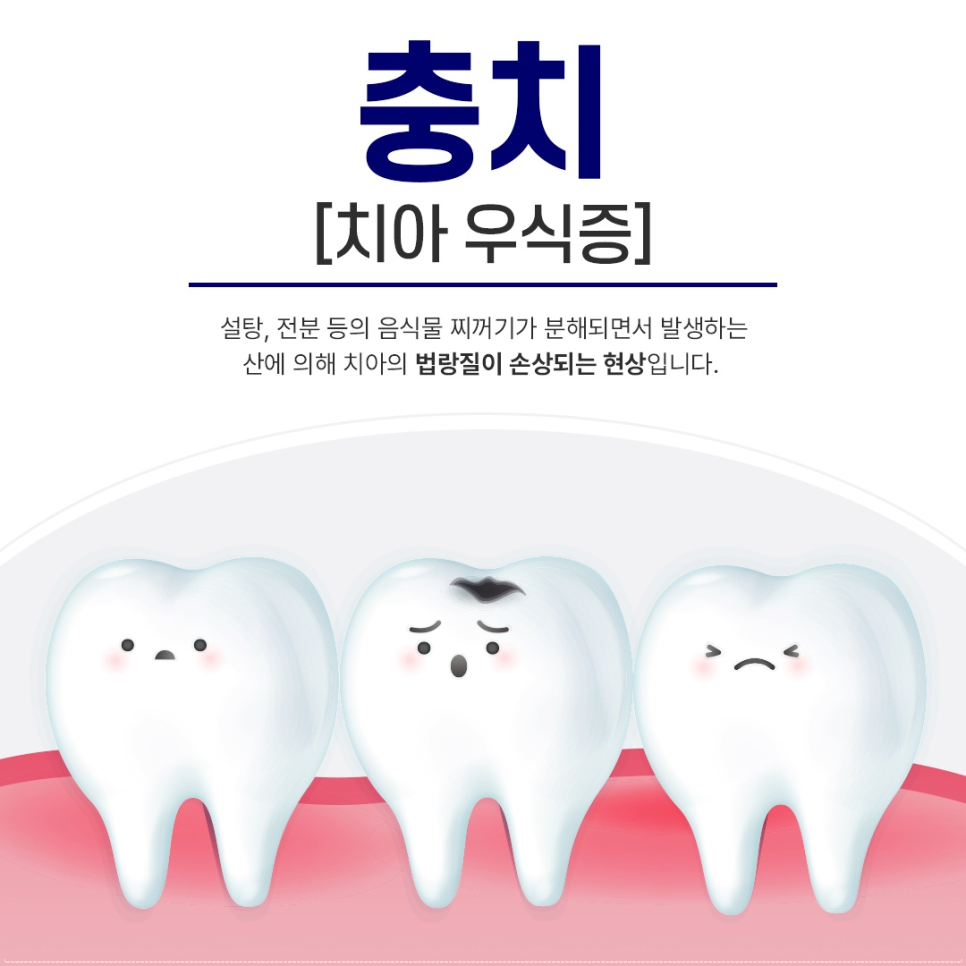 A Guide to Cavity Treatment from Jonggak Station Dental Clinic image 1