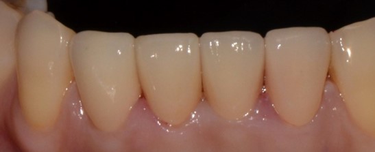 [종로치과추천] 치아가 마모되어 보기 싫어요ㅠㅠ 관련 이미지 3