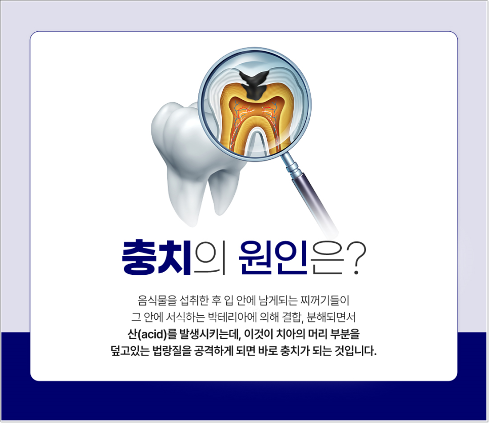 종각역치과 충치를 방치하면 신경치료를 해야 한다. 관련 이미지 4