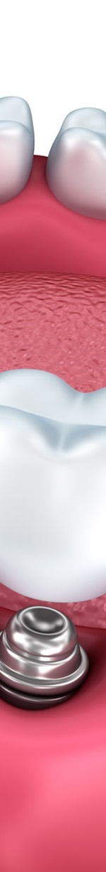 종각역치과 충치를 방치하면 신경치료를 해야 한다. 관련 이미지 15