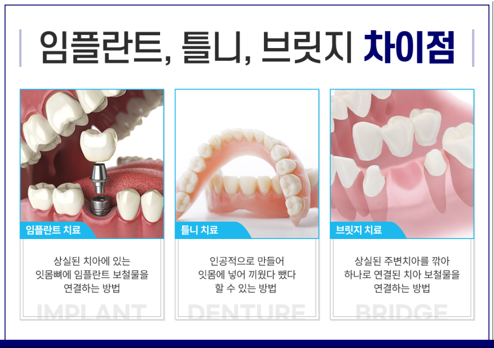 종각역치과 임플란트 치료, 짚고 넘어가세요! 관련 이미지 7