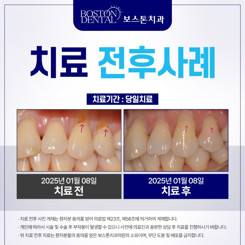 종로치과 치아 마모 때문에 이가 너무 시려요! 관련 이미지 4