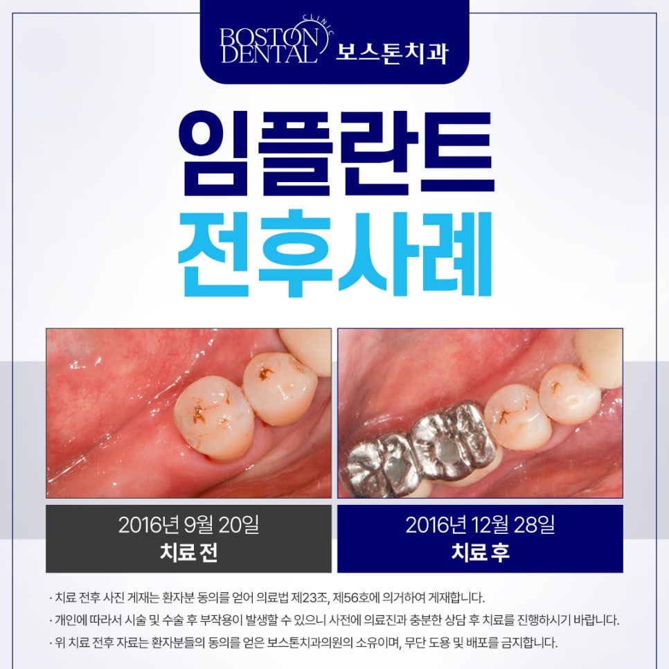 종각치과 오른쪽 어금니를 뺀 지 몇 년 된 것 같아요 관련 이미지 2