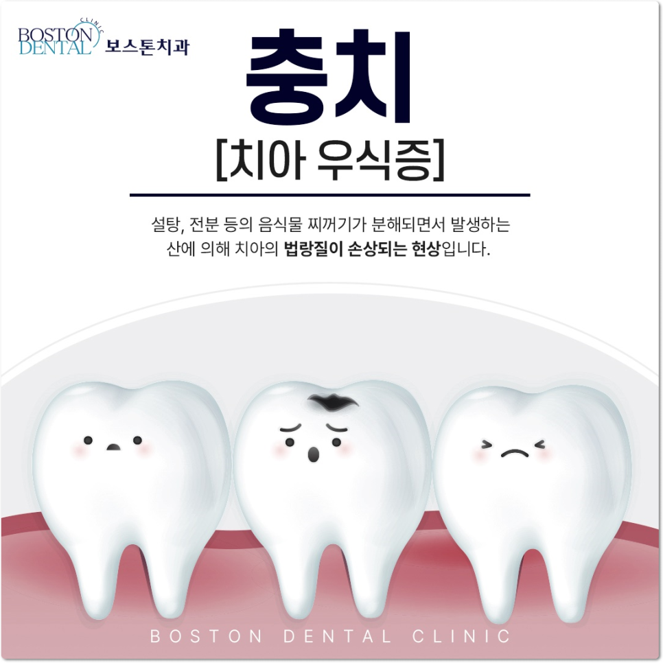 을지로치과 오래된 보철로 앞니가 보기 싫어요ㅠ 관련 이미지 5