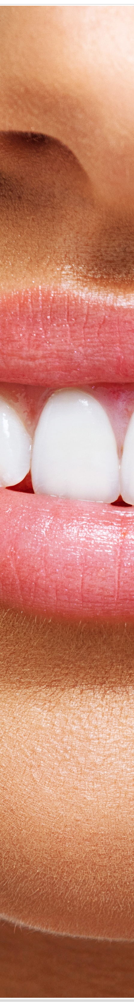 종로치과에서 알려드리는 치아미백과 라미네이트의 모든 것 관련 이미지 14